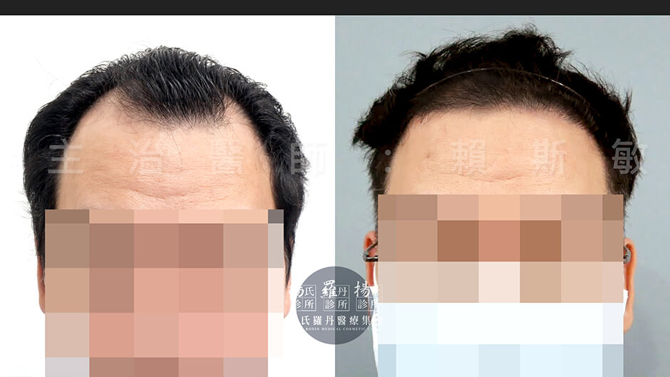 ARTAS  禿頭  植髮  植髮診所